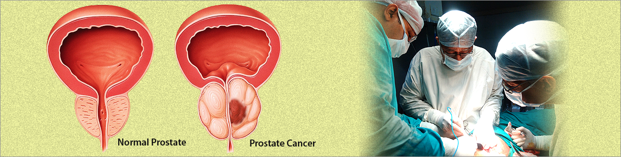 Is prostate cancer deadly